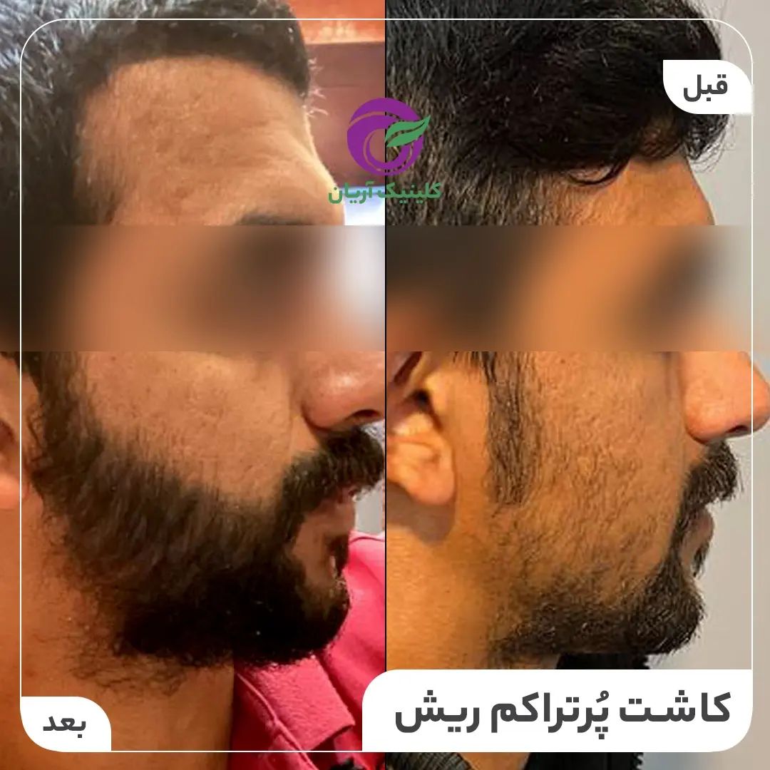 گالری کاشت ریش و سبیل